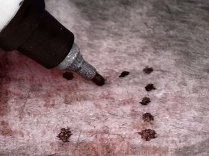 Cutaneous Surgical Denervation: A Method for Testing the Requirement for Nerves in Mouse Models of Skin Disease