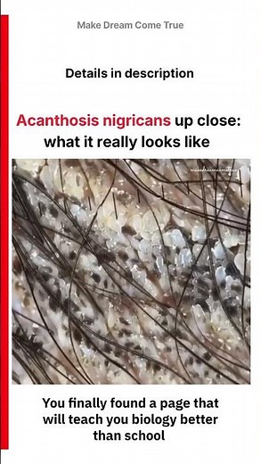 🔬 Acanthosis nigricans up close ⚠️ : what it looks like 🧬 | MDCT