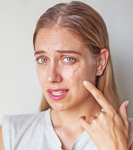 Cystic Acne Treatment: 10 Effective Remedies And Options