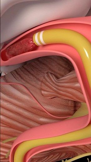 Mechanical Thrombectomy in stroke #medicine #anatomy #science #health #stroke