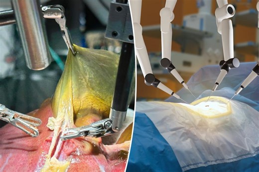 AI-trained robot completes groundbreaking gall bladder operation with 100% success: ‘The future is bright’