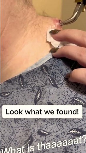 Large Blackheads Extraction Big Cystic Acne Blackheads&Whiteheads Removal Pimple Popping #1027 2026