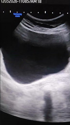 Small Cystocele