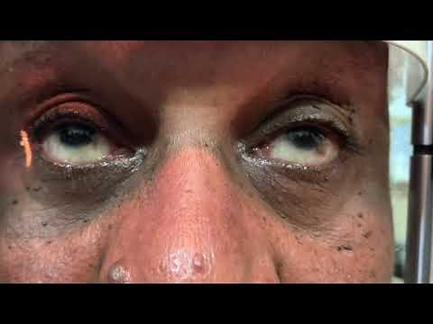 Ocular Myasthenia Gravis (before and after treatment with Mestinon)