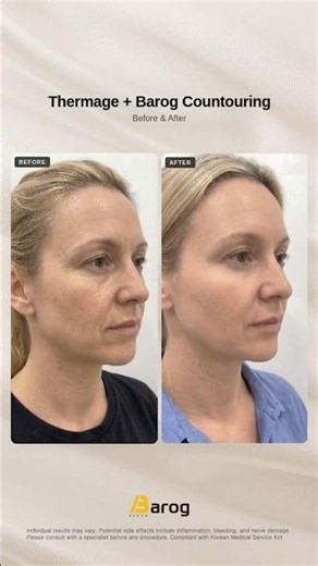 [Gangnam Clinic Seoul: 'Thermage + Barog Contouring Program' Before & After✨]