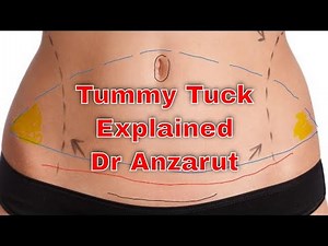 Tummy Tuck Surgery Explained - Everything You Need to Know About Abdominoplasty