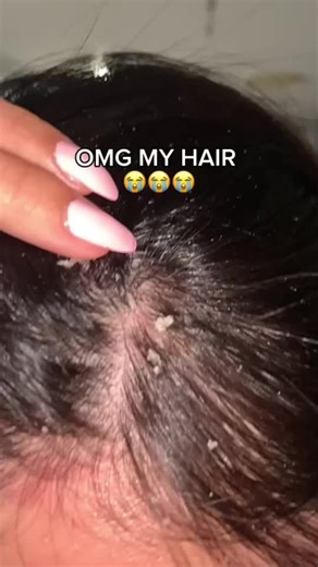 🪮 Dandruff Remover Comb – Winter Scalp Care Essential! 🔥 Special Offer: Get It Now at just Rs.999 🚚 Home Delivery Available 🇳🇵 📞 Order Today: 9766254208 ✨ Remove dandruff instantly & keep your scalp clean this winter! ✅ Deep Scalp Cleaning – Lifts & removes flakes easily ❄️ ✅ Perfect for Winter – Fights dryness & itching 🌬️ ✅ Smooth Rounded Teeth – No hair breakage, no pain 🙌 ✅ Comfortable Grip – Easy to hold & use daily 🤝 ✅ Helps Reduce Hair Fall caused by dandruff 💆‍♂️ ✅ Hygienic & E