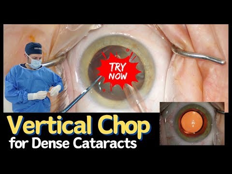 Vertical Chop | A Technique for Dense Cataracts
