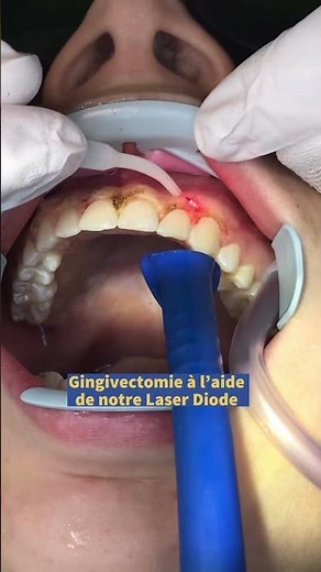 🦷 GINGIVECTOMIE 🦷