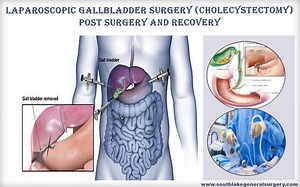 Gallbladder Post-surgery effects and Recovery - Southlake General Surgery