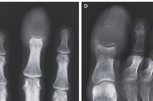 Horrifying images show how man’s finger and toe were replaced by cancerous tumors weeks before his death