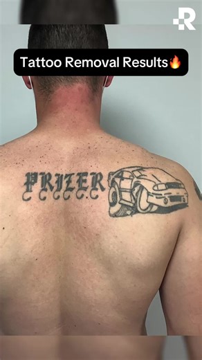 Complete Tattoo Removal After 11 Treatments at Removery