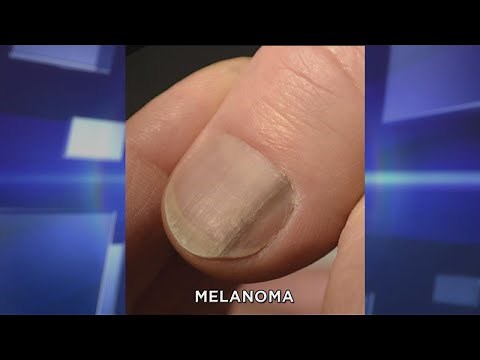 Subungual Melanoma: What You Need to Know