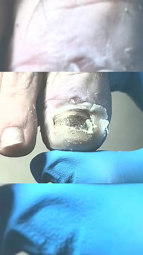 #ingrowntoenail #footcare #feet #podiatrist #pedicure | Dixie Sandoval