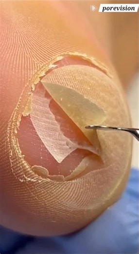 The Great Peeling | Extreme Sole Callus Removal