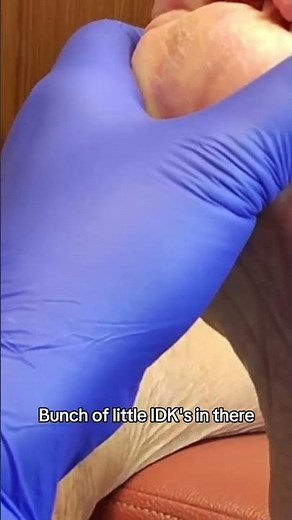 Unusual calluses A close look at a interesting foot condition