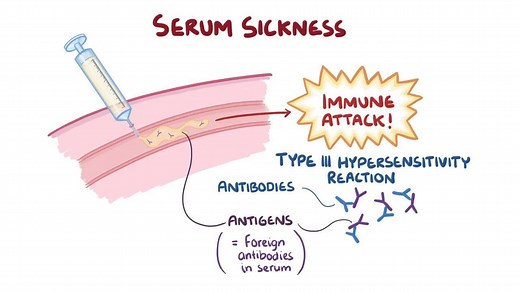 Video: Serum sickness - Video Explanation! | Osmosis | Osmosis
