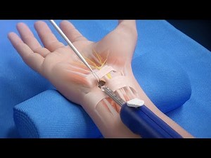NanoScopic™ Release System for Endoscopic Carpal Tunnel Release