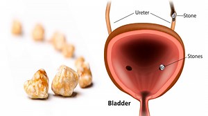 7 Things That Cause Bladder Stones (And How to Prevent Them)