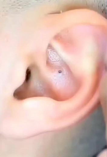 #blackhead #blackheads #blackheadextraction #blackheadremovals #head #cleaning #beautyroutine #satisfying #removal #visage #routine #soin #soinvisage #soins #satisfyingvideo #satisfaction #pimple #pimpleremove #acne #acneskin