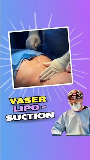 Sculpt Your Back with Precision 💪: VASER Liposuction for Back Fat | Marquis Plastic Surgery