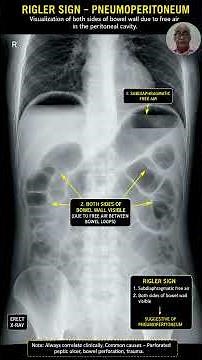 Rigler Sign Explained | Double Wall Sign of Pneumoperitoneum | Life-Saving X-ray Diagnosis