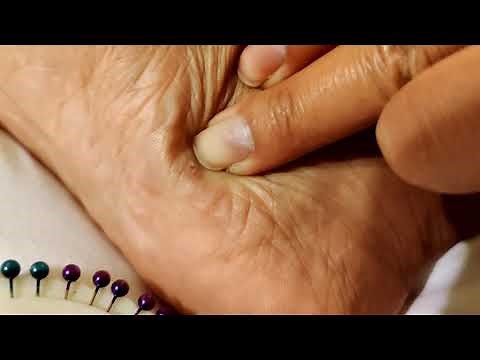 Painful splinter in foot