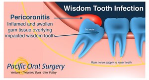 Wisdom Tooth Infection (Pericoronitis) in Ventura, CA - Pacific Oral Surgery