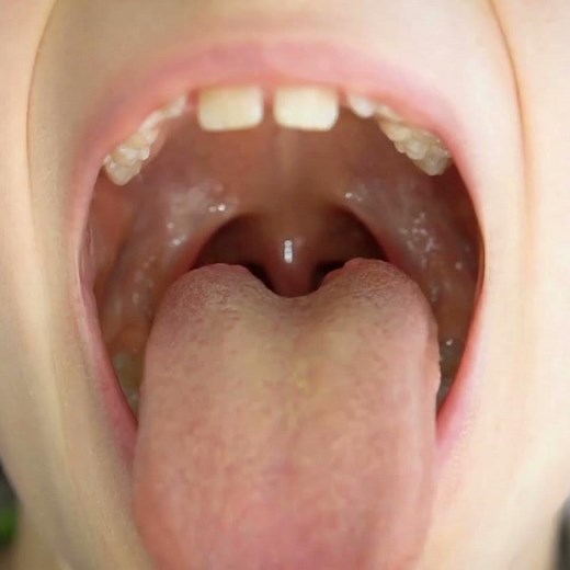 view of the uvula and the soft palate of little girl, pediatric dentistry