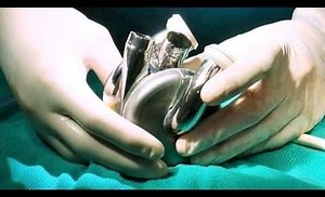 The Texas Heart Institute Implants BiVACOR® Total Artificial Heart – Lifeboat News: The Blog