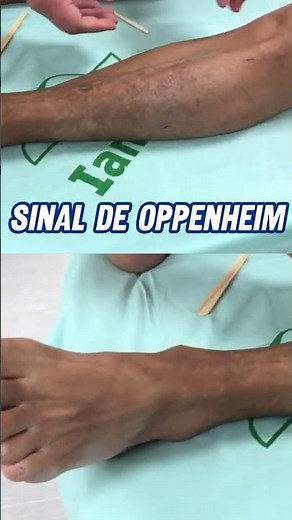 OPPENHEIM SIGN | IMPORTANT NEUROLOGICAL SIGN in stroke