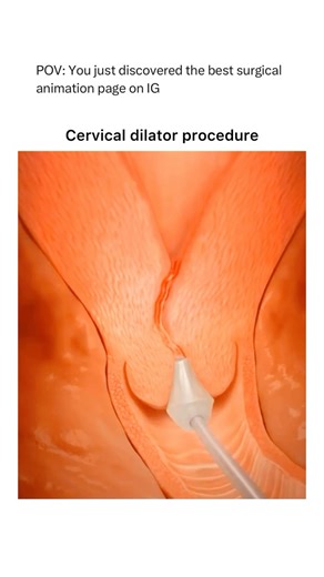 Animations on Instagram: "Follow @surgicalanimation for more! "