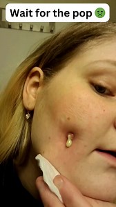 49K views · 159 reactions | My favorite watch 襤 | Pimple Popping | Facebook