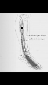 Extensor digitorum longus булчин. Хөлийн хуруу, шагайны тогтвортой байдлын нууц баатар. Энэ булчин нь алхаа, тэнцвэр эрүүл мэндэд маш чухал үүрэгтэй юм. ✅Булчингийн хүч нь сулрахад тавхай унждаг. ✅Гүйгчид, бүжигчид, хөлний биомеханик алдагдсан хүмүүст энэ булчинд ачаалал их очдог. ✅Хавтгай ултай хүмүүст, мөн шилбэний арын булчингийн хатуурлын үед дээрх булчин хэт ачаалал авдаг. Ялган оношлогоо: 1. Артрит 2. Захын мэдрэлийн эмгэг Эмчилгээнд хамрагдан алхаа, тэнцвэр сайжирсны дараа ч 1. Өдөр бүр х