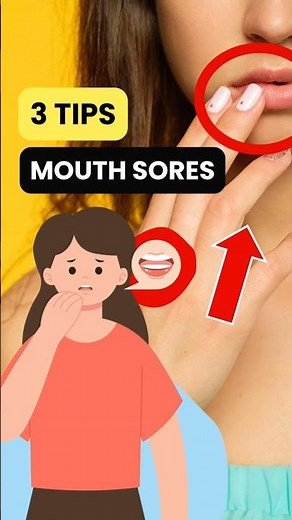 3 Tips to Stop Chemo Mouth Sores | Chemo Side Effects (part 81)