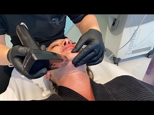 MORPHEUS8 GAVE ME A SNATCHED JAWLINE | RADIOFREQUENCY MICRONEEDLING TREATMENT | Dr. Jason Emer