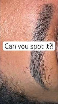 I Thought Every Eyebrow Hair Was Transplanted… I Was Wrong 👀