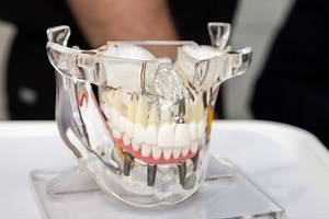 Cost Of Dental Implants | Columbia, MD | Dental Implant Price