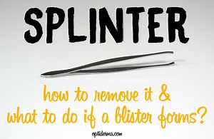 How to Remove a Splinter & What to Do if a Splinter Causes a Blister?