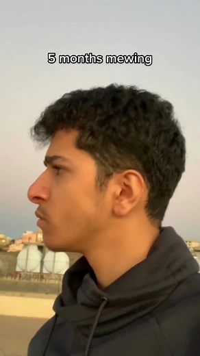 5-Month Mewing Progress: Jawline Transformation