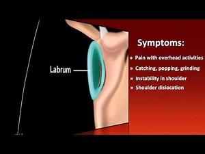USC Athletics Injury Report - Shoulder Labral Tear