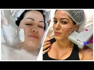 Ultraformer III OU ultrassom microfocado? Resultado 100 dias depois ..