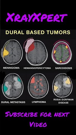 Dural Based Tumors in Brain #anatomy #medicalimaging #medical #xray #nurse #yt #xraytechnologist