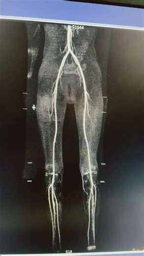 MRA Lower limb non- contrast angio #angiography #MRA #MRA