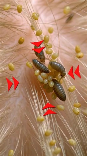 Head Lice : Why so difficult to be eradicated? #insects #wildlife