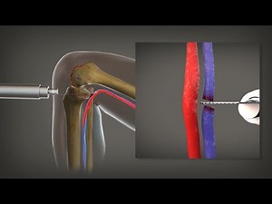 7-Figure Settlement: Leg Amputated After Blood Vessels Damaged During Knee Replacement