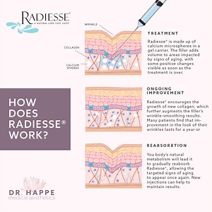 Radiesse for Hands and Face | Boston | Dr. Holly Happe