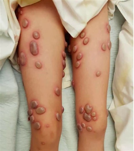 Diagnosis? A 7 y/o girl with a 2-week history of fever and with several days of painful blisters on her arms, legs, and face. Two weeks earlier, she had completed a course of penicillin for tonsillitis. - On hospital day 5, a new skin ulcer developed on the right hand at an intravenous cannula site. -Histopathologic findings revealed edema and a diffuse infiltration of neutrophils in the papillary dermis with swollen endothelial cells. | Infamou Boundaries