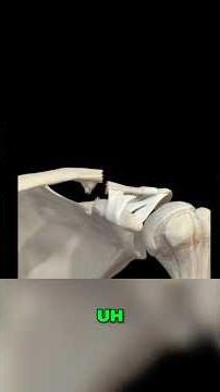 Clavicle Fracture: Types, Impact, and Recovery Explained! #shorts