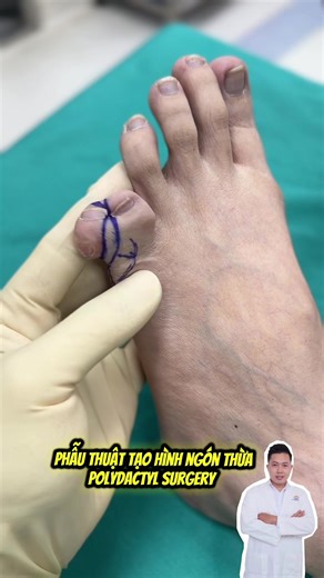 Polydactyly surgery removes an extra finger or toe to improve function and appearance ❤️ #polydactyl #polydactylsurgery #tatthuangon #thuangontay #thuangonchan #phauthuatthuangon